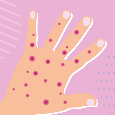 Choroba zakaźna Zestaw testowy PCR w czasie rzeczywistym Monkeypox MPXV Zarejestrowany przez CE 1 test/pudełko